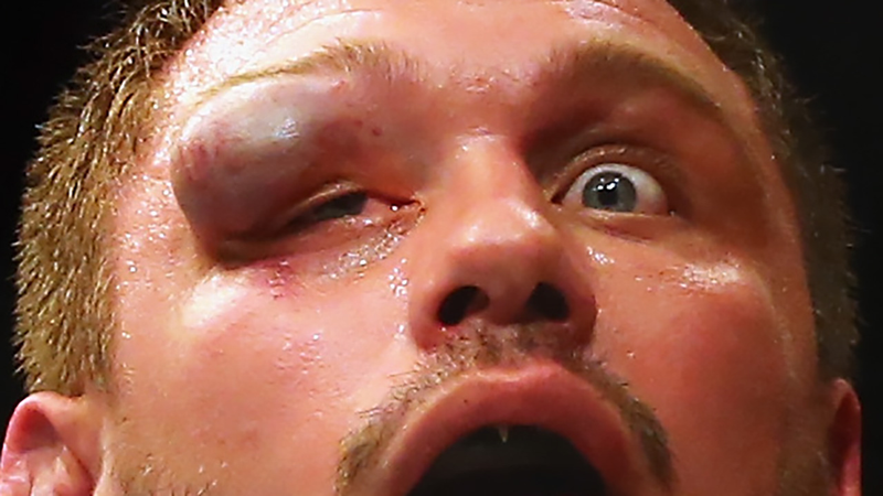 Illustration for article titled Matt Mitrione's Eye Is So Gross We Had To Censor It For You